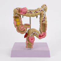 Intestinal Pathology Model Molded Plastic Colon Anatomy Model Anatomical Anatomical Model Freestanding Medical Learning Resource