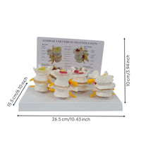 Diseased Spine Comparison Model Medical Spine Model with Card Educational for Teachers, Students, Musculoskeletal Teaching, Practice Setting Display