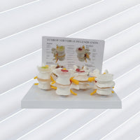 Diseased Spine Comparison Model Medical Spine Model with Card Educational for Teachers, Students, Musculoskeletal Teaching, Practice Setting Display