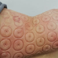Thickened Magnetic Acupuncture Cupping Therapy Set