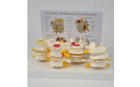 Diseased Spine Comparison Model Medical Spine Model with Card Educational for Teachers, Students, Musculoskeletal Teaching, Practice Setting Display