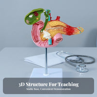 Pancreas Pathology Model Gallbladder Pathology Model Gallstones